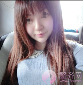 北京鼻部手术案例术后220天日记
