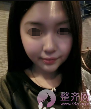 北京鼻部手术案例术后220天日记