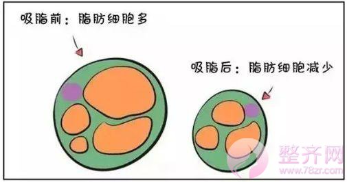 吸脂瘦身,这个夏天做个一身轻松的女人~