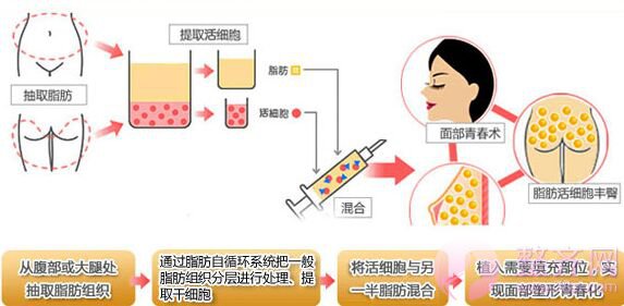 面部脂肪填充你所不知道的~