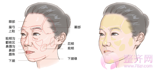 面部脂肪填充你所不知道的~