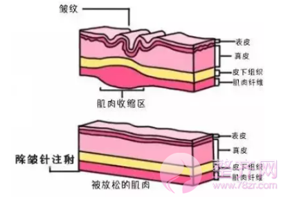 如何快速有的除去皱纹？