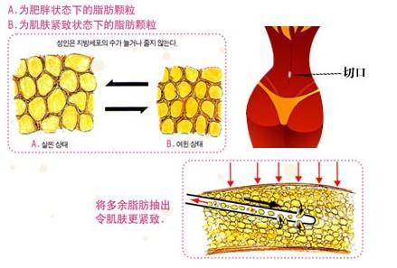 北京艺美王东吸脂怎么样？价格案例分享