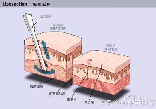 北京艺美王东吸脂怎么样？价格案例分享