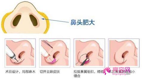 佛山美莱隆鼻怎么样？价格案例分享