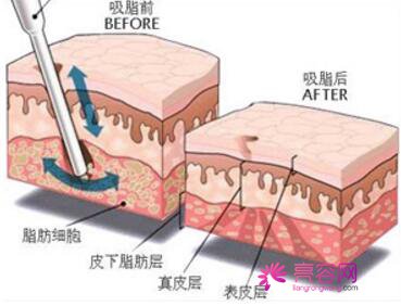 南京美莱吸脂怎么样？价格案例分享