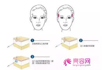 成都玉之光刘中国自体脂肪填充怎么样？价格案例分享