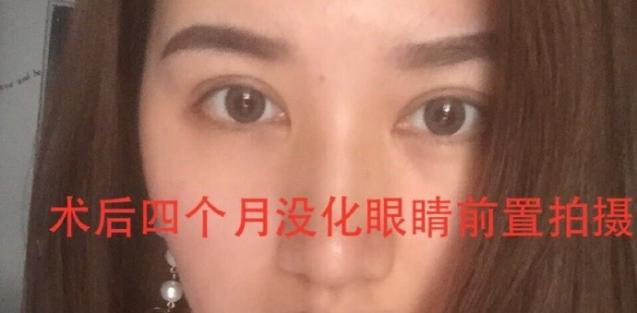 成都华美陈扬主任做的双眼皮+开眼角+提肌