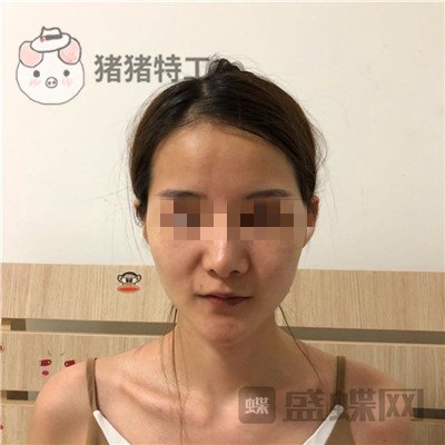 福州美贝尔原上海九院赵栋材面部填充案例价格分享，做完皮肤感觉在发光~~