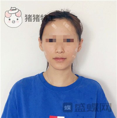 哈尔滨美联致美侯锋玉面部填充案例价格分享，现在我就像一个高中生~