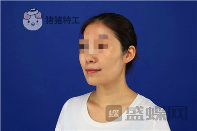 重庆华美陈凯面部填充案例价格分享，妈妈变成姐姐的惊奇改变!