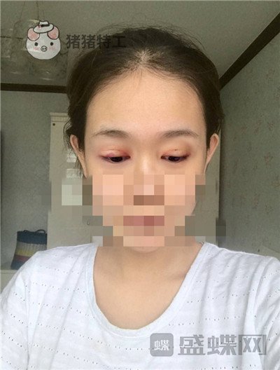 杭州美莱韩超双眼皮案例价格分享，做个双眼皮朋友以为我去换了个头？？