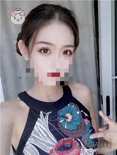 杭州美莱韩超双眼皮案例价格分享，做个双眼皮朋友以为我去换了个头？？