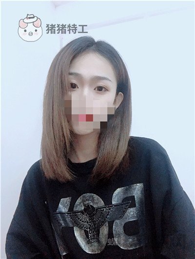 杭州美莱韩超双眼皮案例价格分享，做个双眼皮朋友以为我去换了个头？？