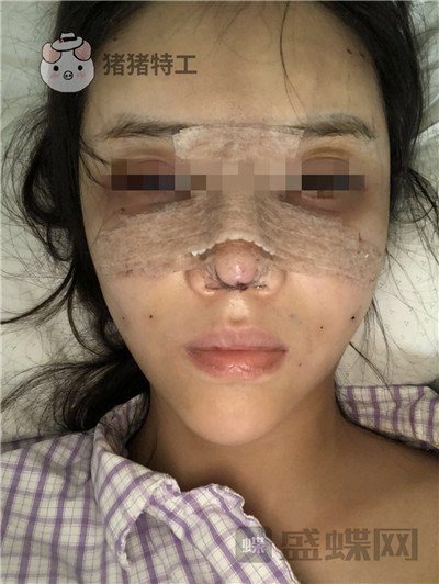 上海华美李健面部填充案例价格分享，开始脸肿的样子以为整失败了。