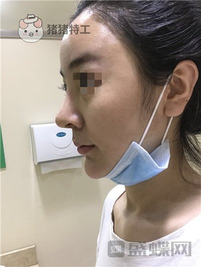 上海华美李庭勋隆鼻案例价格分享，这张混血脸你招架得住吗？