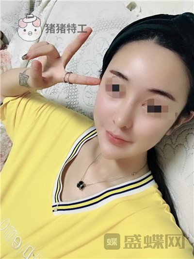 上海华美李庭勋隆鼻案例价格分享，这张混血脸你招架得住吗？