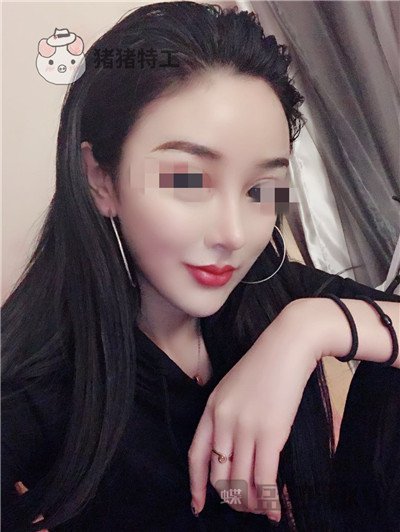 上海华美李庭勋隆鼻案例价格分享，这张混血脸你招架得住吗？