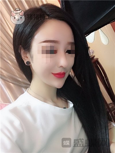 上海华美李庭勋隆鼻案例价格分享，这张混血脸你招架得住吗？