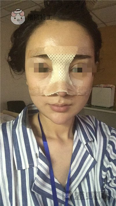 上海华美李庭勋隆鼻案例价格分享，这张混血脸你招架得住吗？