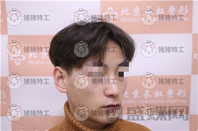 北京长虹于志宏鼻部手术案例价格分享，追求完美的男神现在如愿以偿。