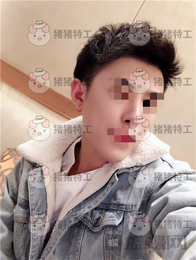 上海华美叶丽萍​垫下巴案例价格分享，谁说只有女孩子尖尖下巴好看？