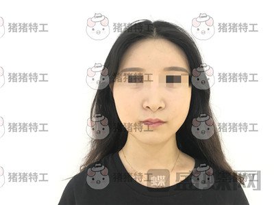 上海华美李志海下颌角整形案例价格分享，眼瞅着这张脸小了整整两圈。。