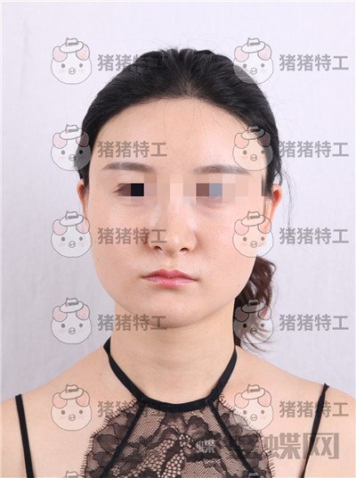 上海华美李志海下颌角整形案例价格分享，眼瞅着这张脸小了整整两圈。。