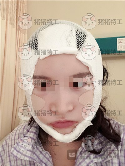 上海华美李志海下颌角整形案例价格分享，眼瞅着这张脸小了整整两圈。。