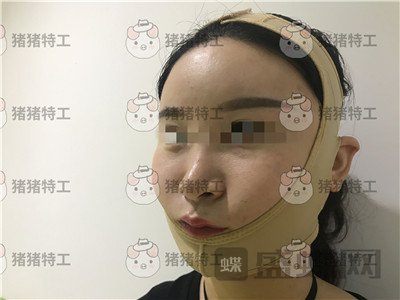 上海华美李志海下颌角整形案例价格分享，眼瞅着这张脸小了整整两圈。。