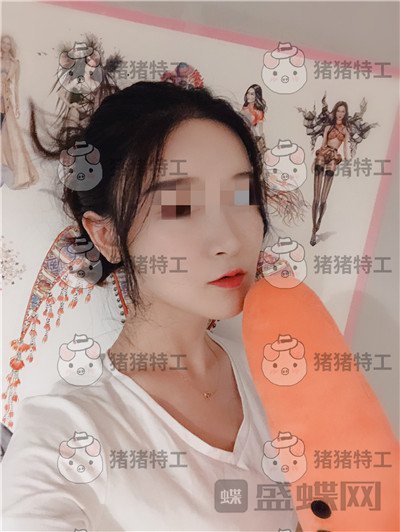 上海华美李志海下颌角整形案例价格分享，眼瞅着这张脸小了整整两圈。。