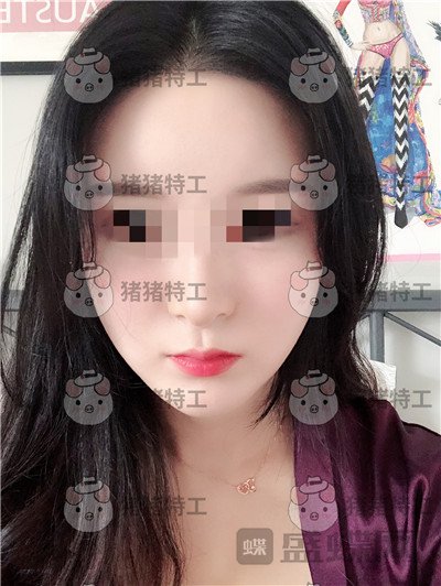 上海华美李志海下颌角整形案例价格分享，眼瞅着这张脸小了整整两圈。。