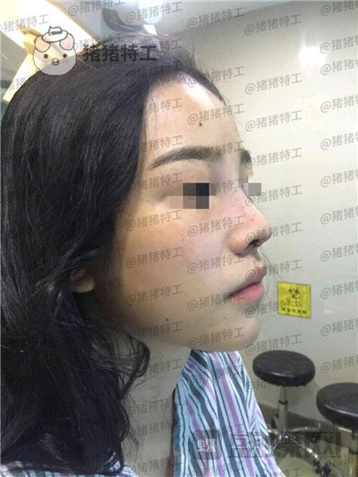 重庆铂生杜亚旭​鼻部手术案例价格分享，做出来的鼻子到底自然吗？