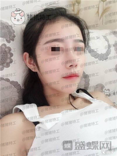 重庆铂生杜亚旭​鼻部手术案例价格分享，做出来的鼻子到底自然吗？