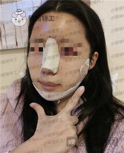 上海九院张盈帆​隆鼻案例价格分享，仙女的鼻子是怎么养成的？