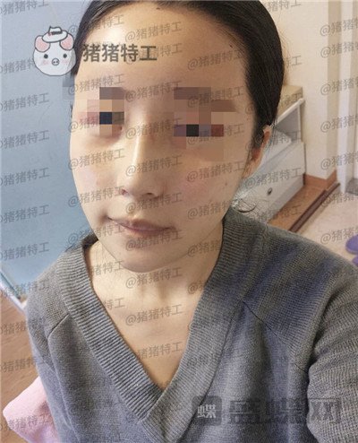 上海九院张盈帆​隆鼻案例价格分享，仙女的鼻子是怎么养成的？