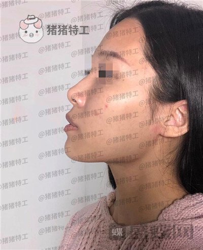 上海九院张盈帆​隆鼻案例价格分享，仙女的鼻子是怎么养成的？