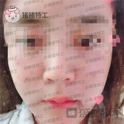 北京美莱宋延刚面部填充案例价格分享，直接年轻十五岁的果太惊艳了！