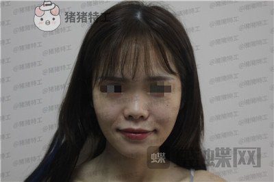 成都西区医院车红昌隆鼻案例价格分享，做完变仙女自拍前置像头都很好看~