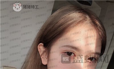 广东画美牟北平双眼皮案例价格分享，想要自然双眼皮的小仙女注意啦！