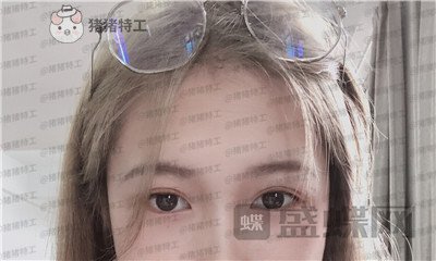 广东画美牟北平双眼皮案例价格分享，想要自然双眼皮的小仙女注意啦！