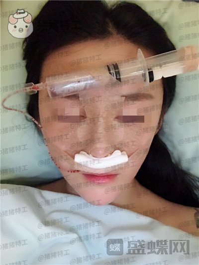 重庆华美蒋琳​隆鼻案例价格分享，仙女隆鼻之后是一种是什么体验？