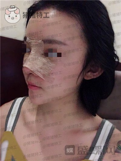 重庆华美蒋琳​隆鼻案例价格分享，仙女隆鼻之后是一种是什么体验？