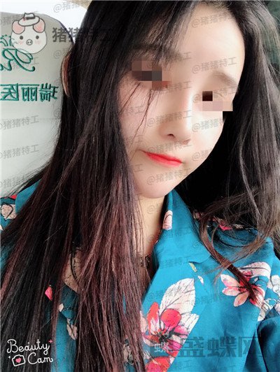 重庆华美蒋琳​隆鼻案例价格分享，仙女隆鼻之后是一种是什么体验？