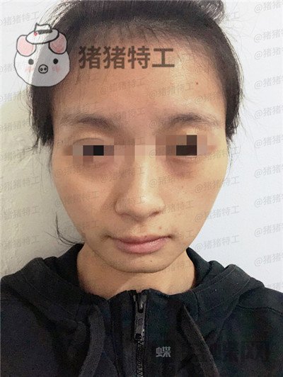 天津南开欧菲闫腾元面部填充案例价格分享，老阿姨蜕变小仙女.