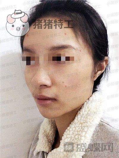 天津南开欧菲闫腾元面部填充案例价格分享，老阿姨蜕变小仙女.