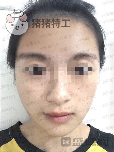 天津南开欧菲闫腾元面部填充案例价格分享，老阿姨蜕变小仙女.