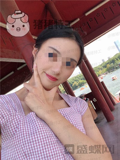 天津南开欧菲闫腾元面部填充案例价格分享，老阿姨蜕变小仙女.