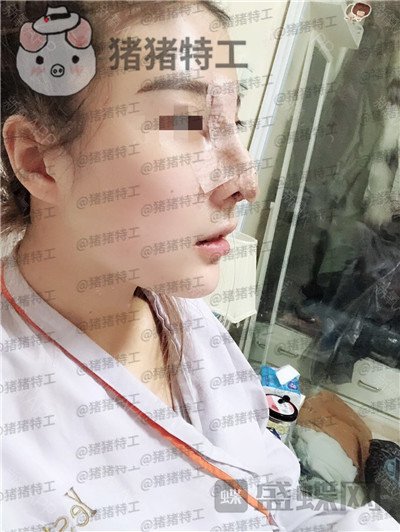 上海艺星李建兵隆鼻案例价格分享，鼻子真的就是完美侧颜的重点。