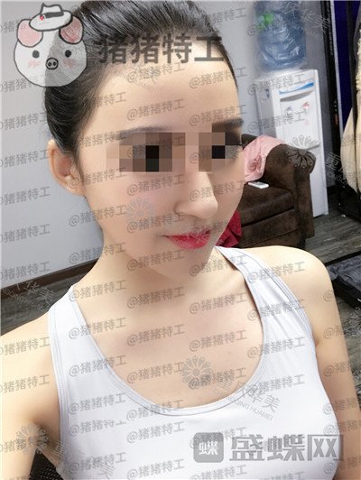 重庆华美潘宝华颧骨整形案例价格分享，堪称换头术的一次重大改变！